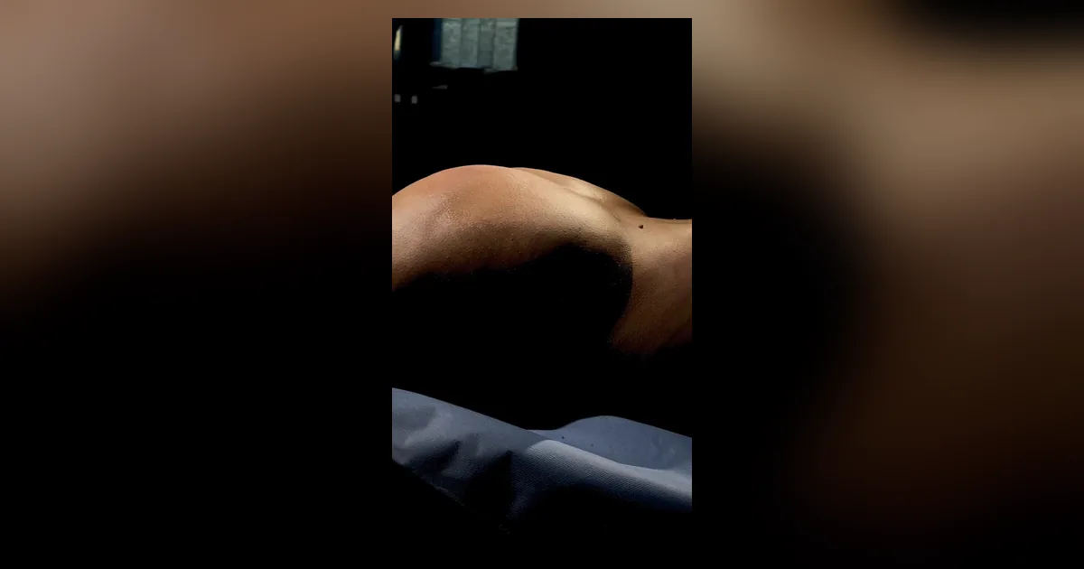Aumento de glúteo com gordura e correção de hip dips