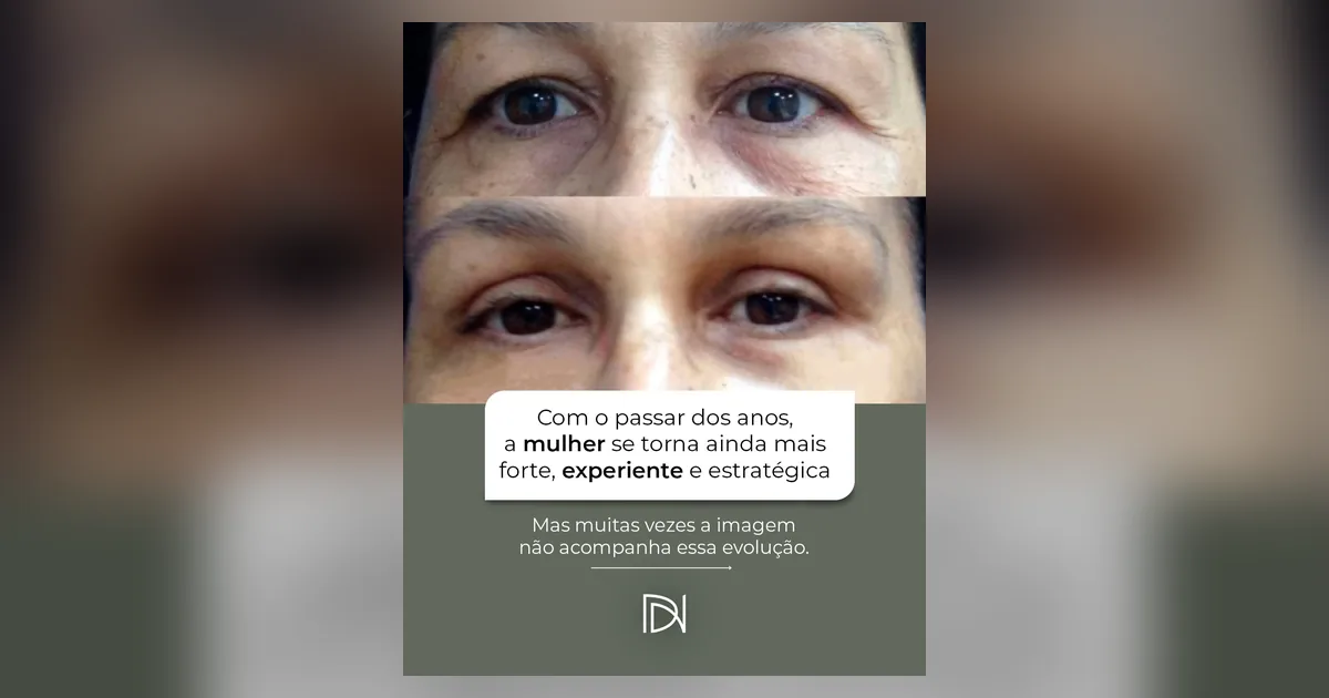 Olhar cansado mesmo descansada? Pode ser a pálpebra