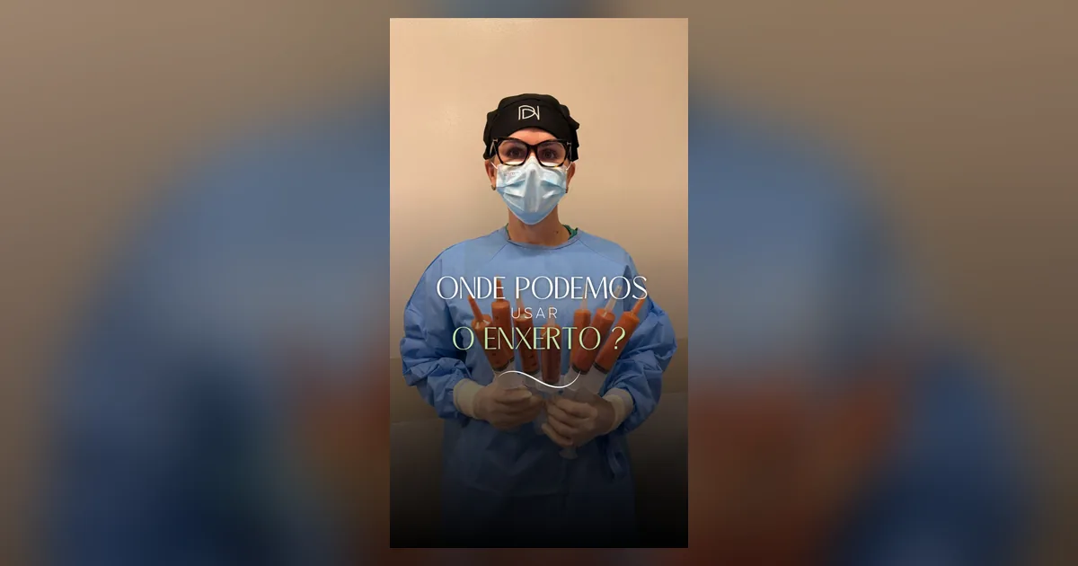 Onde o enxerto de gordura pode ser usado no rosto e no corpo