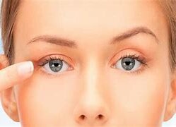 Blefaroplastia